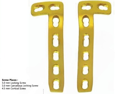 L – Buttress Locking Plate